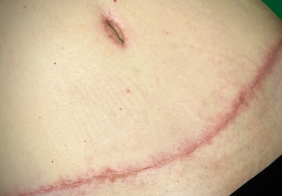 terapia blizn